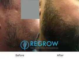 ReGrow- Hair restoration  888-897-5899